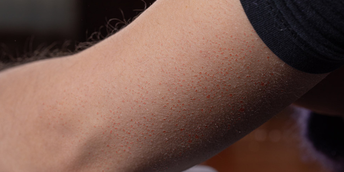 Keratosis pilaris: hoe behandel je die kippenvel bultjes?