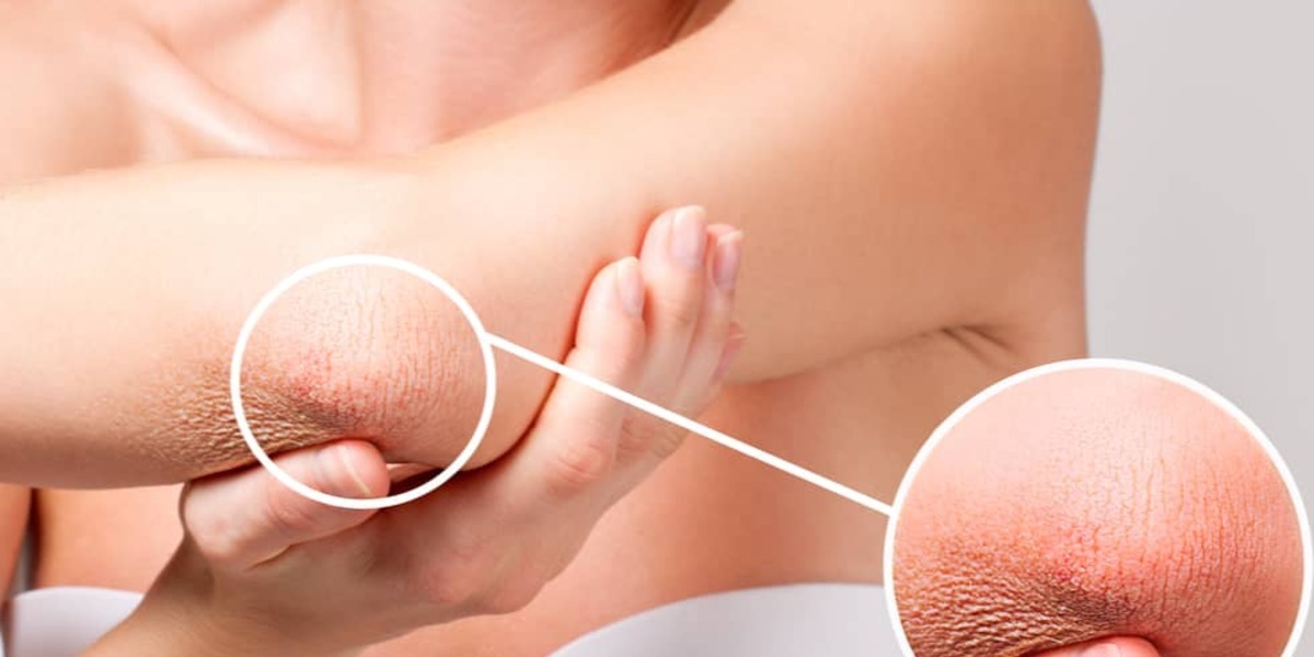 Wat te doen tegen een droge huid?