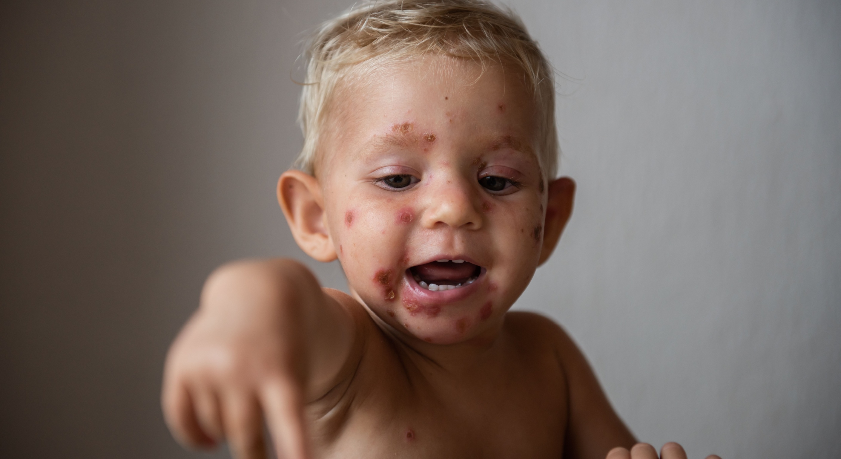 Wat is impetigo?